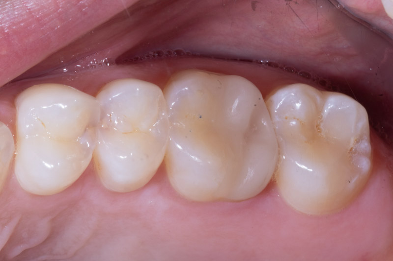 Same Day Cerec Crown After